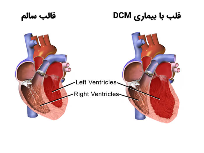 نارسایی قلبی کاردیومیوپاتی متسع (DCM)